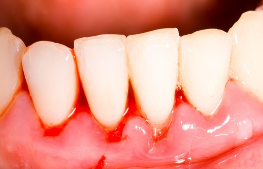 Por qué me sangran las y cómo puedo tratar este problema? - Dental Clinic