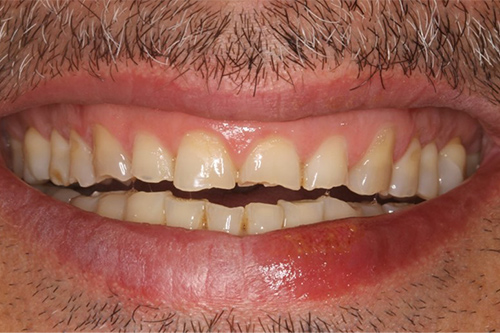 fotografía de una dentadura previa a recibir una Rehabilitación Completa