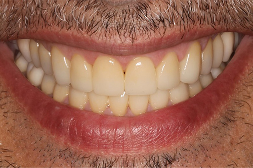 fotografía de una dentadura después de haberse sometido a una Rehabilitación Completa