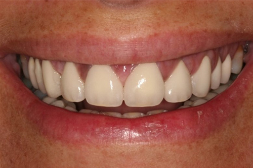 fotografía de una dentadura después de haberse sometido a una Rehabilitación Completa