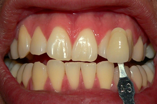 Fotografía que muestra unos dientes con color amarillo previo al blanqueamiento dental