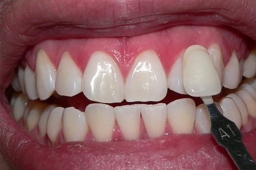 Fotografía que muestra uno dientes blancos después de haber recibido un blanqueamiento dental