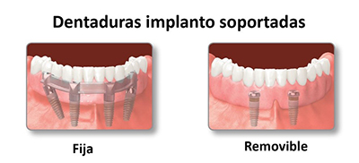 la imagen presenta dos Dentaduras implanto soportadas, la primera fija y la segunda removible