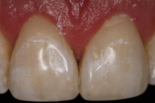 Se muestra los mismo dientes de la imagen anterior la cual muestra el diente izquierdo reparado