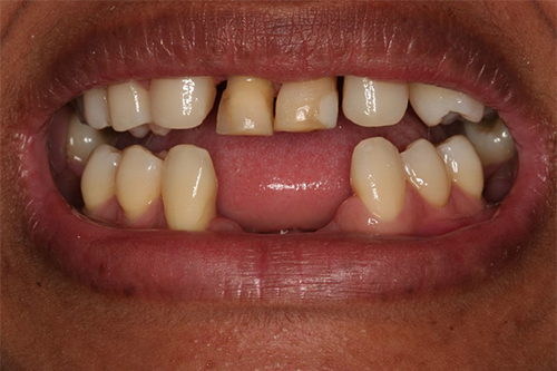 Dentadura previa al tratamiento de implante dental