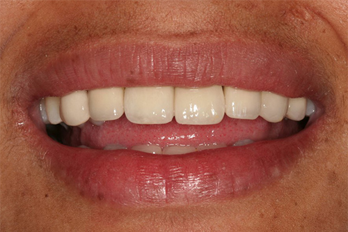 Dentadura después de realizado el tratamiento de implante dental