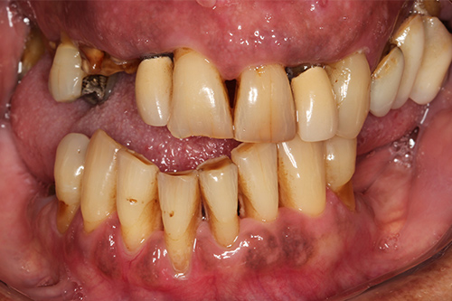 Dentadura previa al tratamiento de implante dental