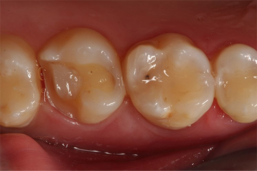 Ejemplo de un diente previo a una incrustación dental