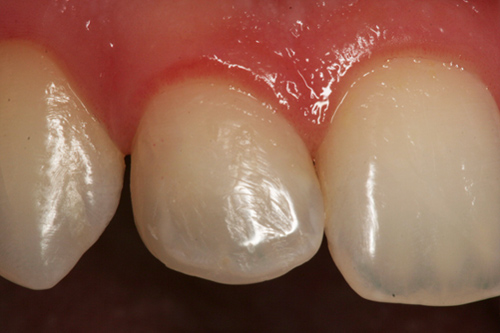 fotografía de un diente esculpido con resina y es un materiales que se usa para restauraciones estéticas