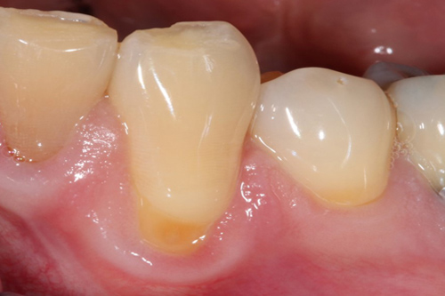 fotografía de un diente previo a recibir periodoncia
