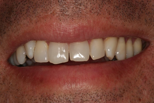 fotografía de una dentadura previa a recibir un Recontorneo Cosmético