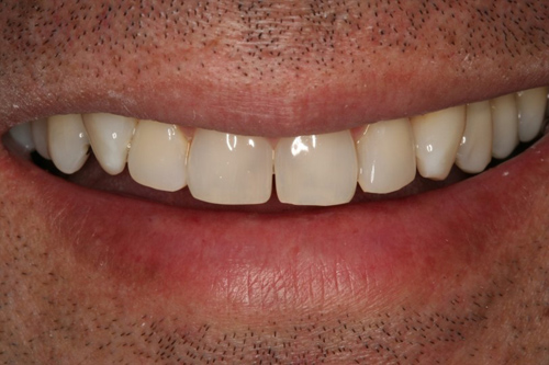 fotografía de una dentadura después de haberse sometido a un Recontorneo Cosmético