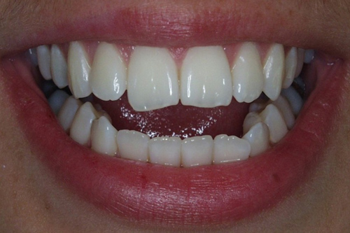 fotografía de una dentadura previa a recibir un Recontorneo Cosmético