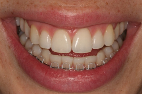 fotografía de una dentadura después de haberse sometido a un Recontorneo Cosmético
