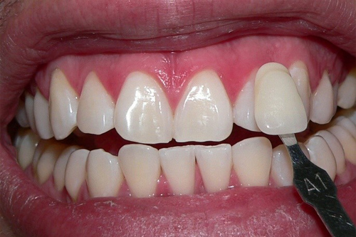 blanqueamiento dental despues