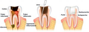 endodoncia procedimiento