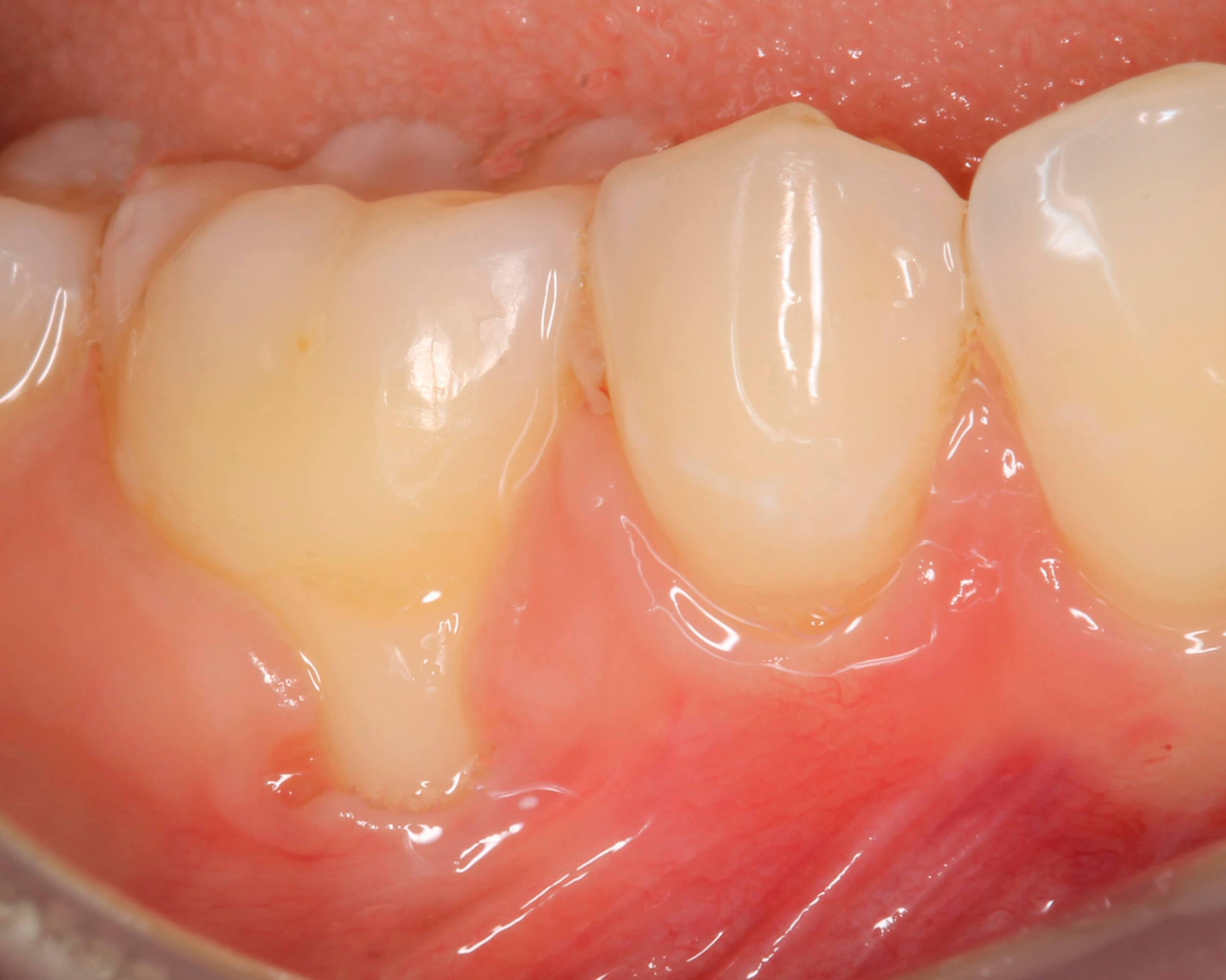 periodoncia injerto de encia antes - costa rica