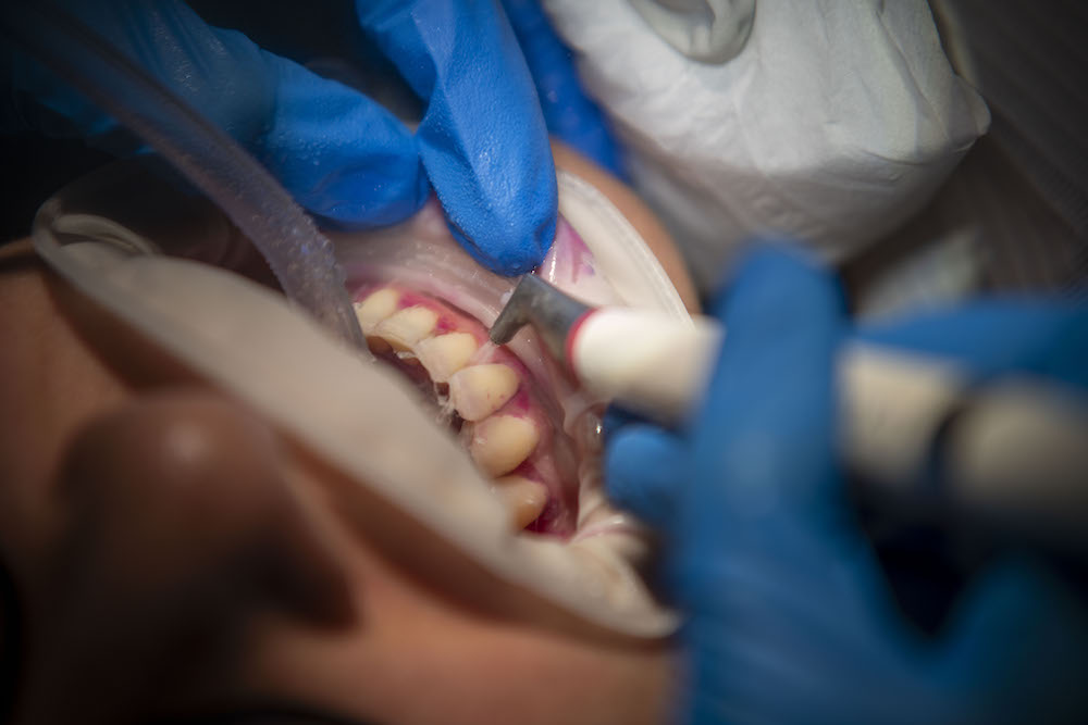 Protocolo Guided-Biofilm Therapy en paciente